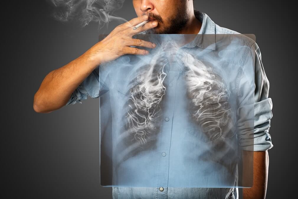 Fumar aumenta el riesgo de cáncer de pulmón