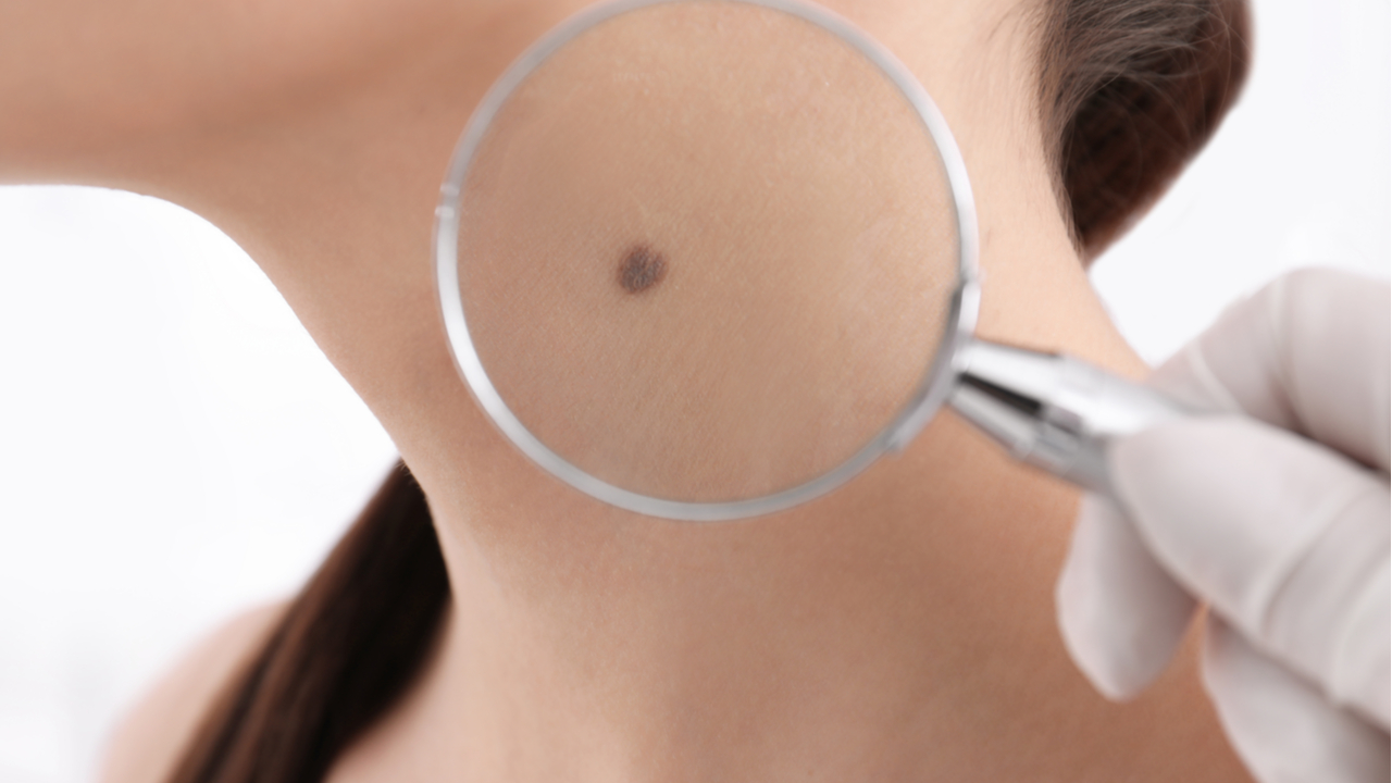 cómo identificar los primeros síntomas de cáncer piel