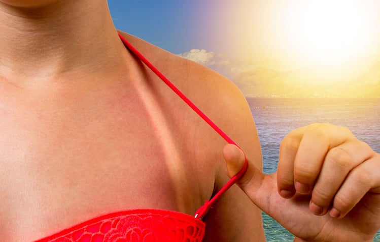 Quemaduras solares en verano y riesgo de cancer