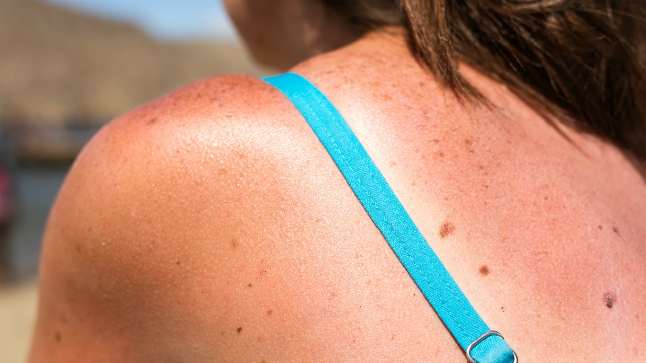 expocision al sol puede causar insolacion y quemaduras en la piel