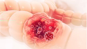 Qué es el examen de Thevenon y detección temprana del cáncer de colon