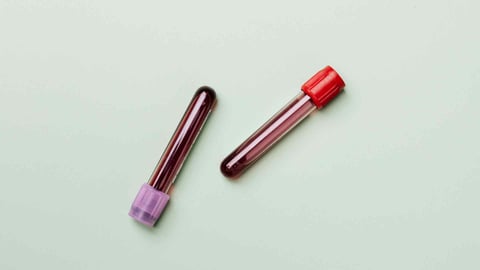 Anemia Ferropénica: Causas, Síntomas, Tratamiento