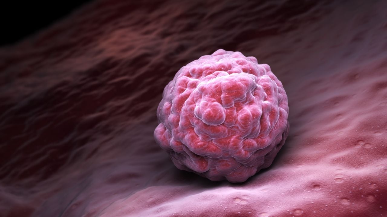 biopsia de seno hallazgos sospechosos