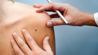 cancer-de-piel-tipo-melanoma-2.png
