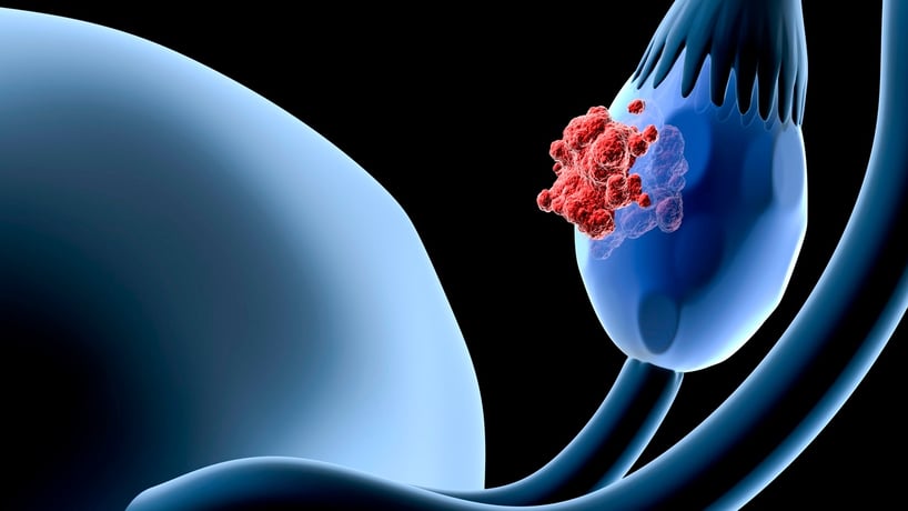 descripción gráfica de un ovario con cáncer