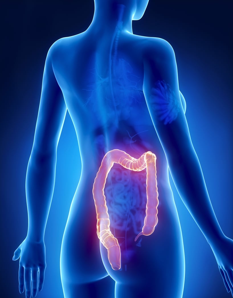 intestino sintomas del cancer de colon