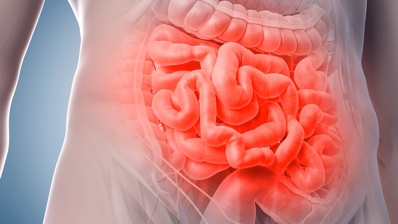 Diverticulitis