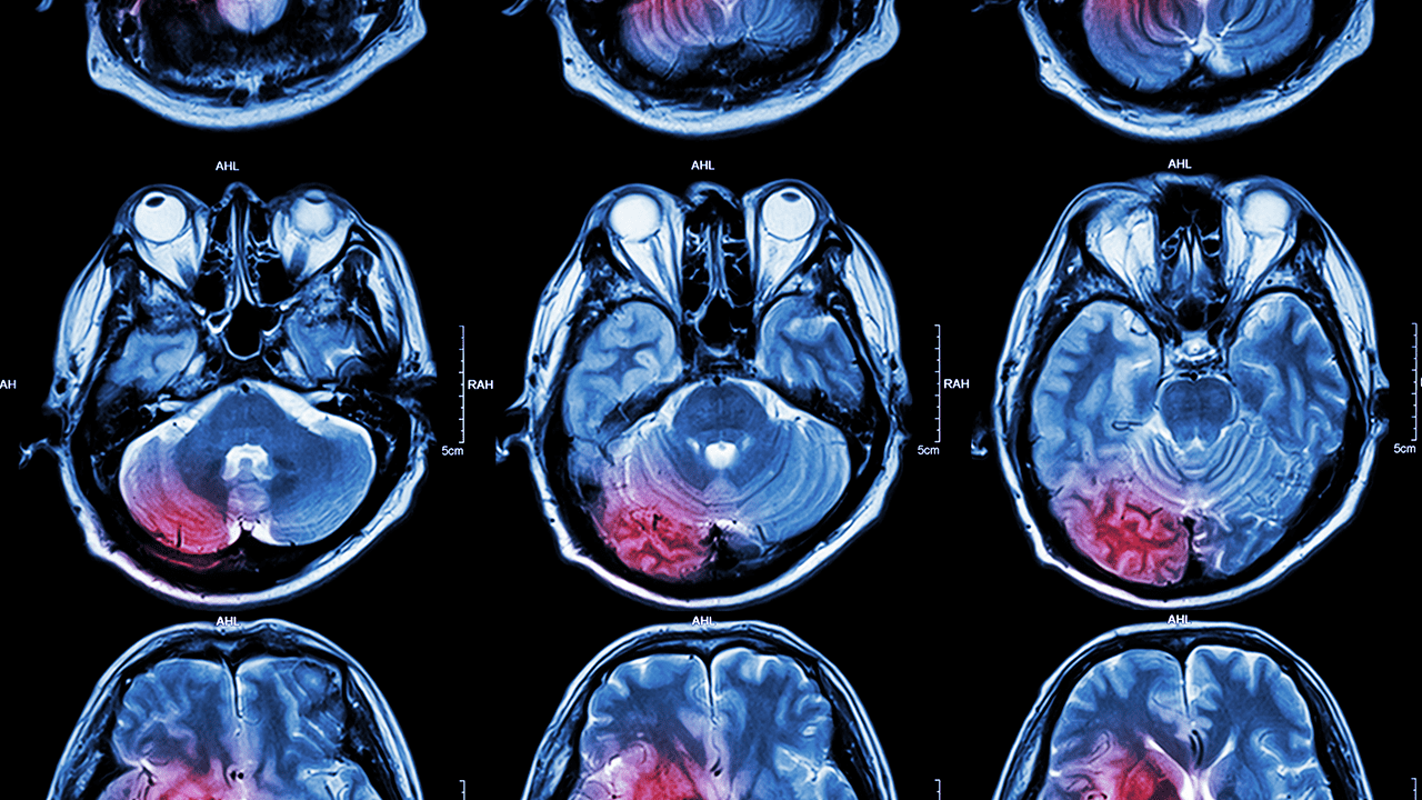 cancer-de-cerebro