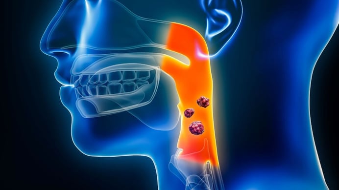 cancer de laringe por consumo de tabaco