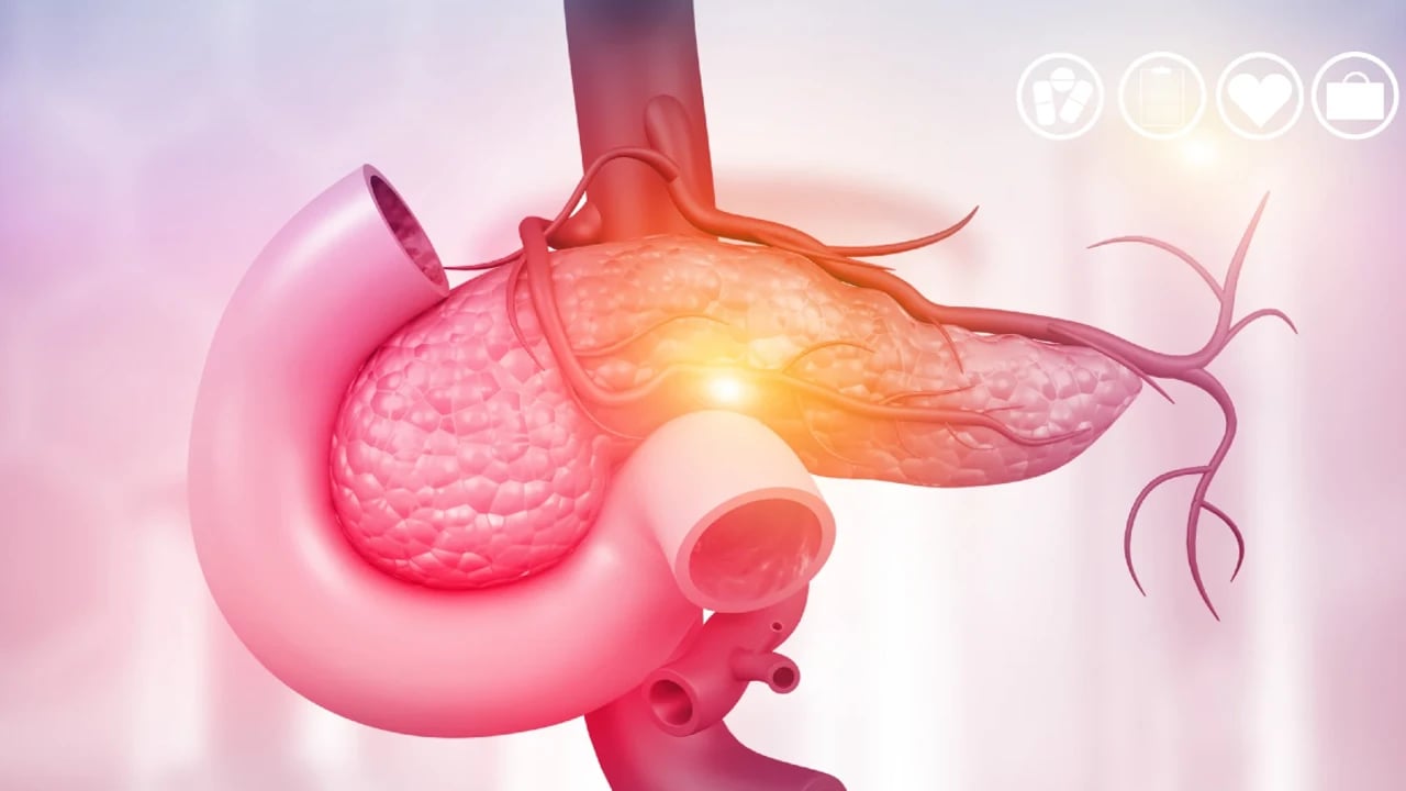 cancer de pancreas que es y cuales son sus sintomas