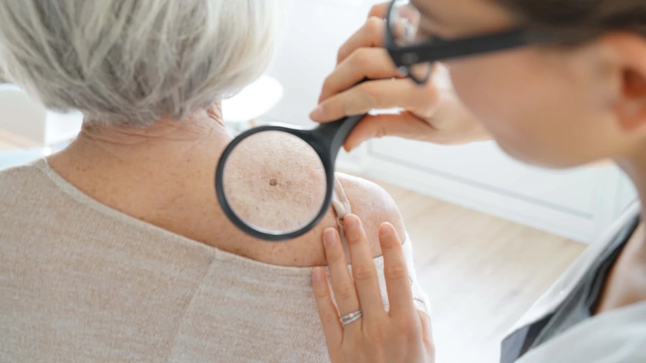cancer de piel en mujeres adultas