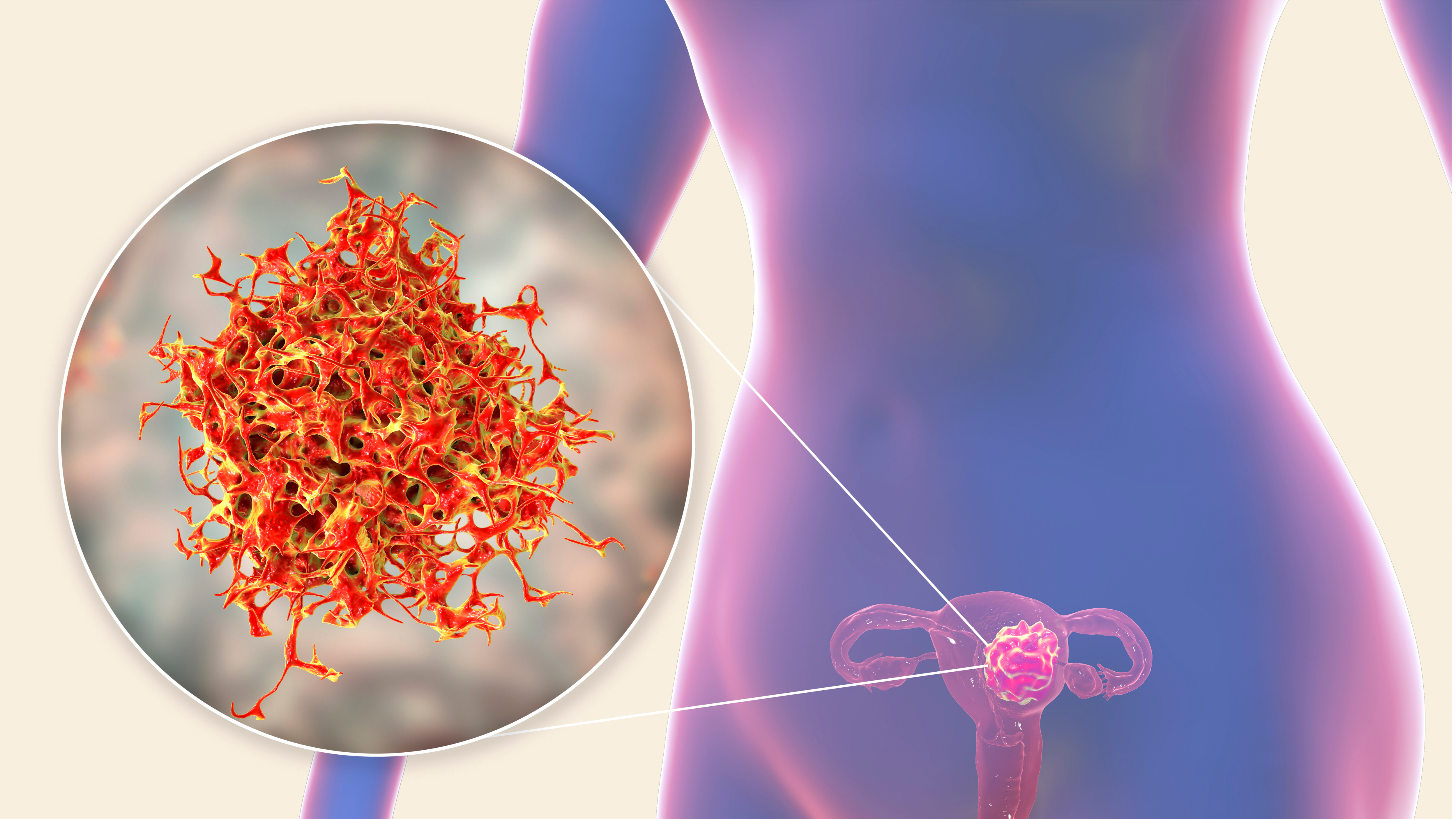 como se previene el cancer de utero