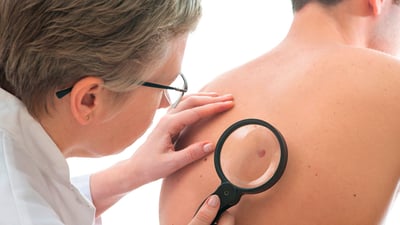 ¿Qué exámenes debes hacerte para detectar el cáncer de piel?