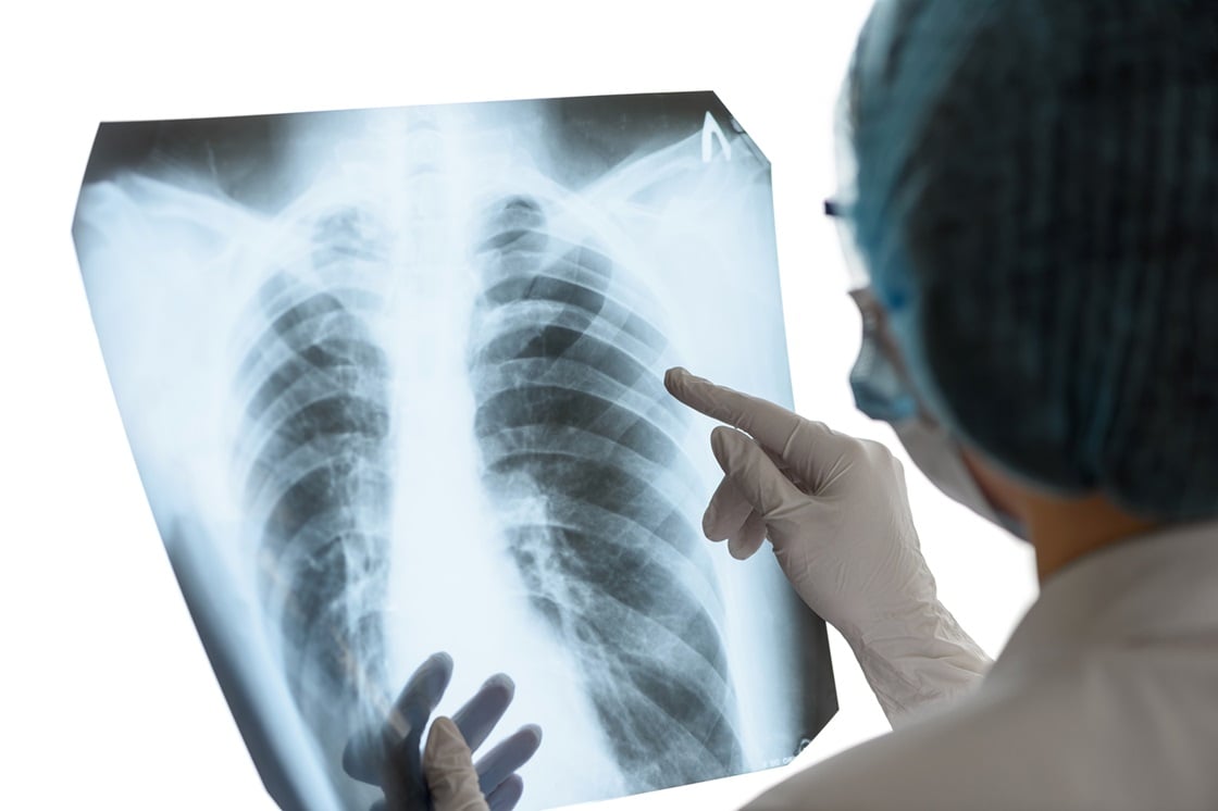 fibrosis pulmonar 4