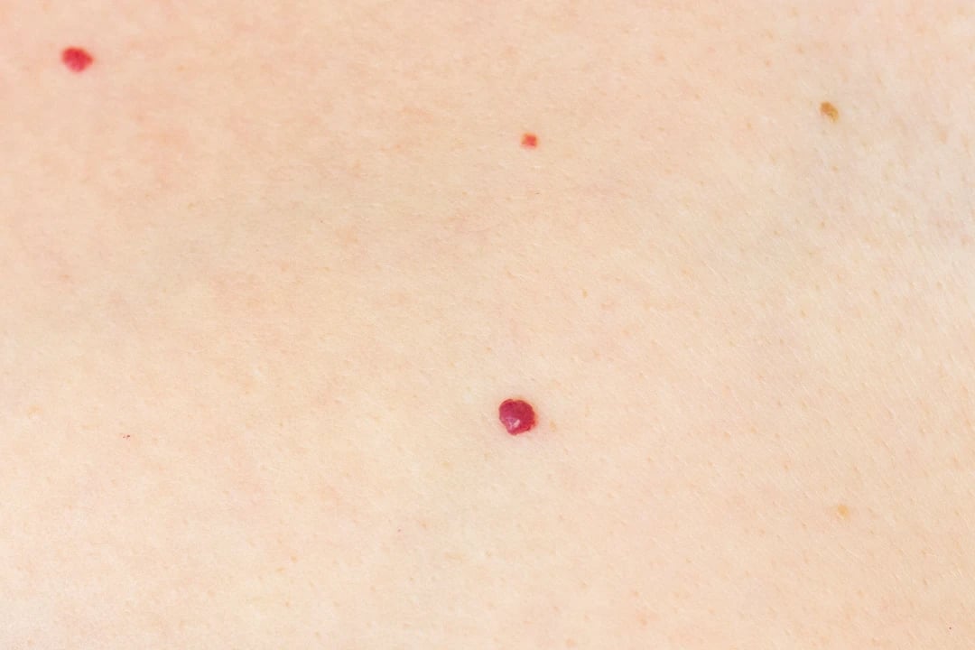 manchas rojas en la piel fotos de angiomas