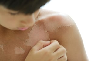 Aprende a prevenir el cáncer de piel en niños con estos tips