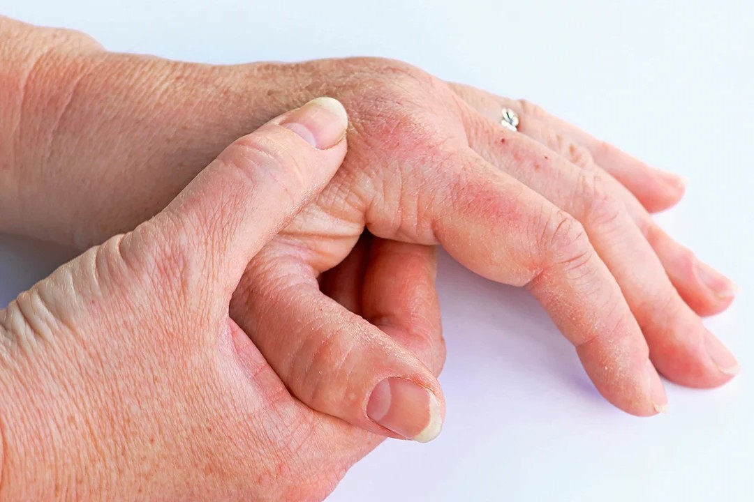 psoriasis enfermedades piel comun adulto mayor