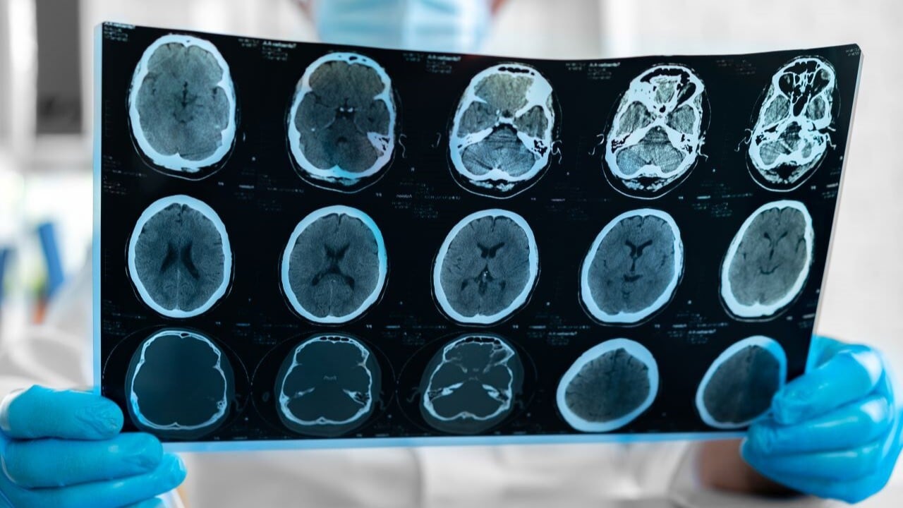 que es un glioma y como se forma