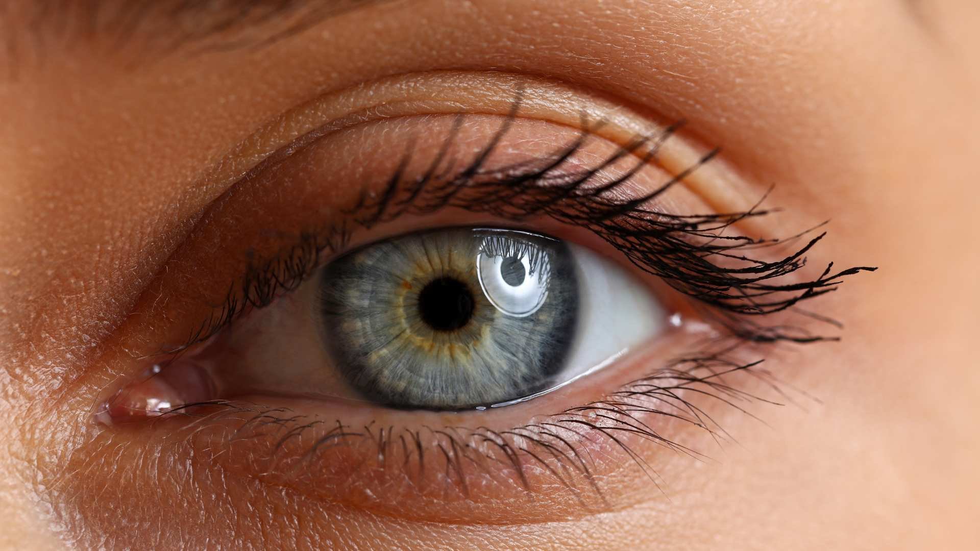 Edema Bipalpebral