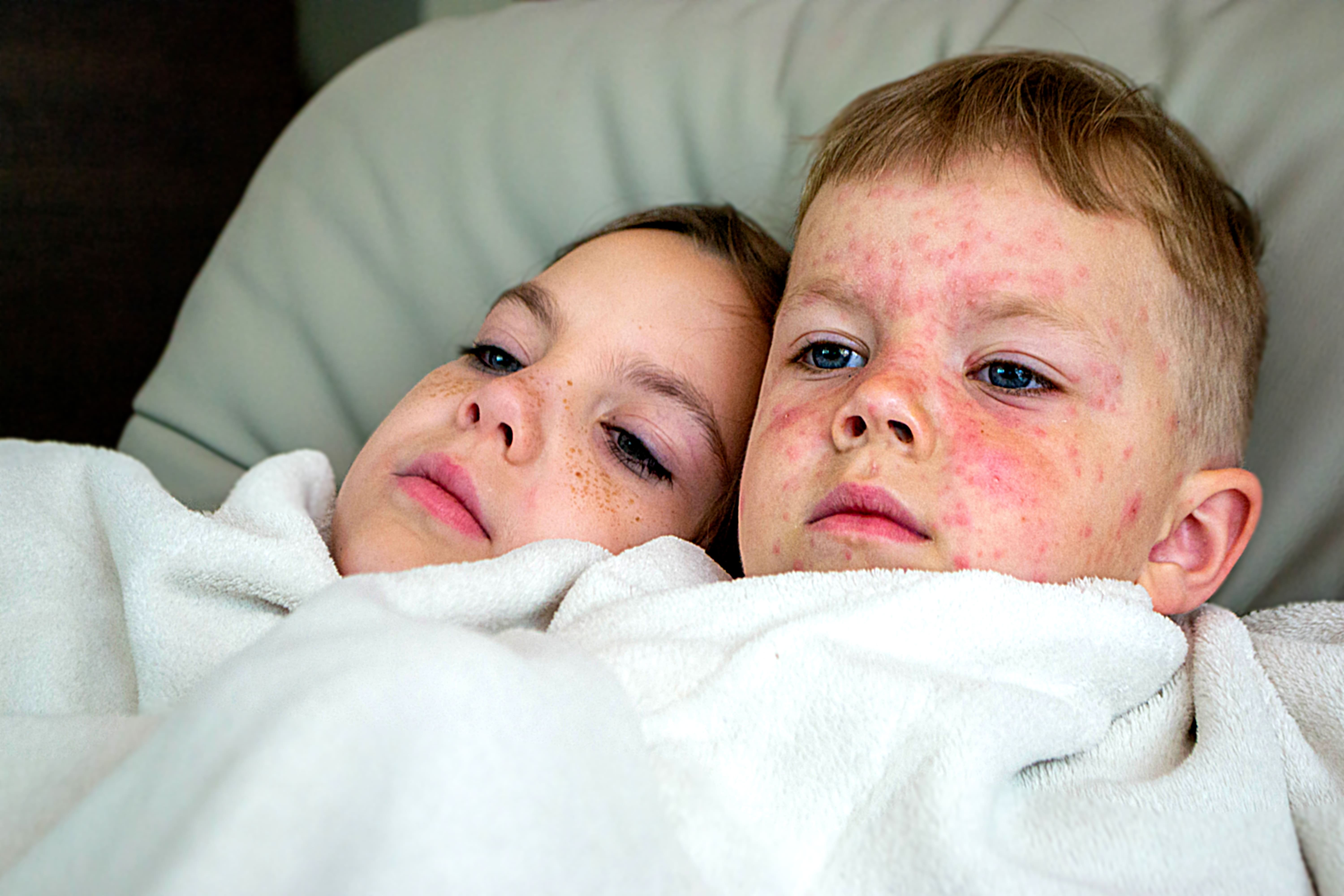 varicela en niños 