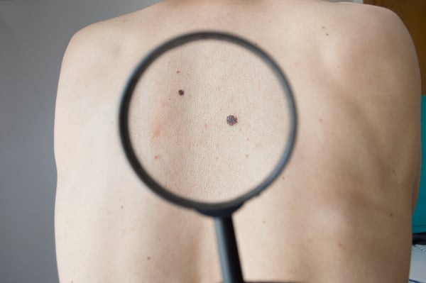 inflamacion de lunares