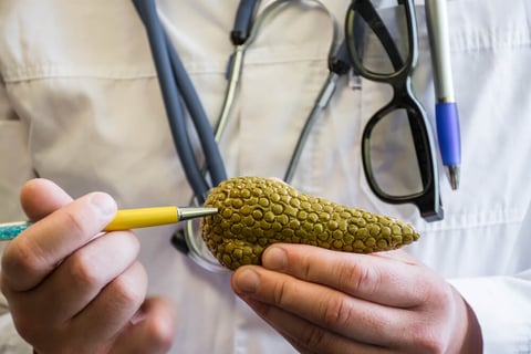 Cuanto Tarda En Desarrollarse Un Cáncer De Páncreas
