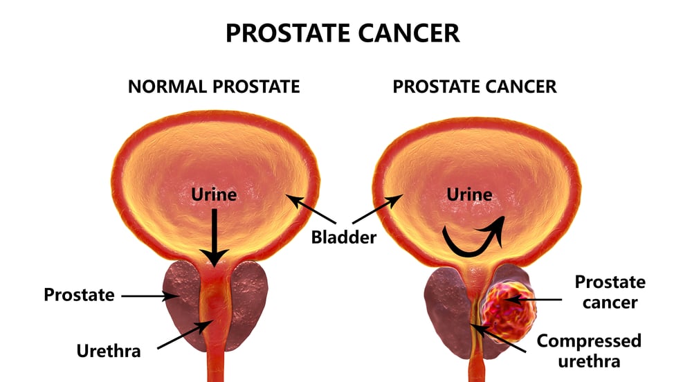 un hombre operado de la próstata puede embarazar a una mujer