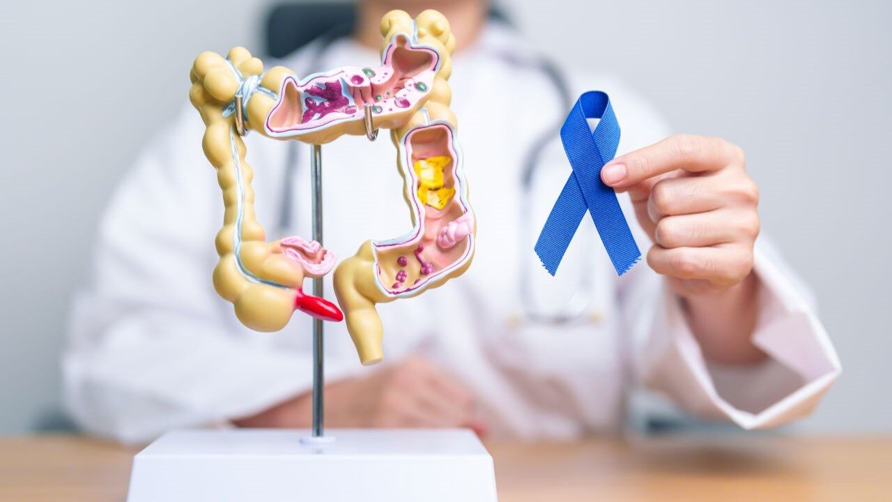 sindrome de lynch y el cancer de colon prevencion