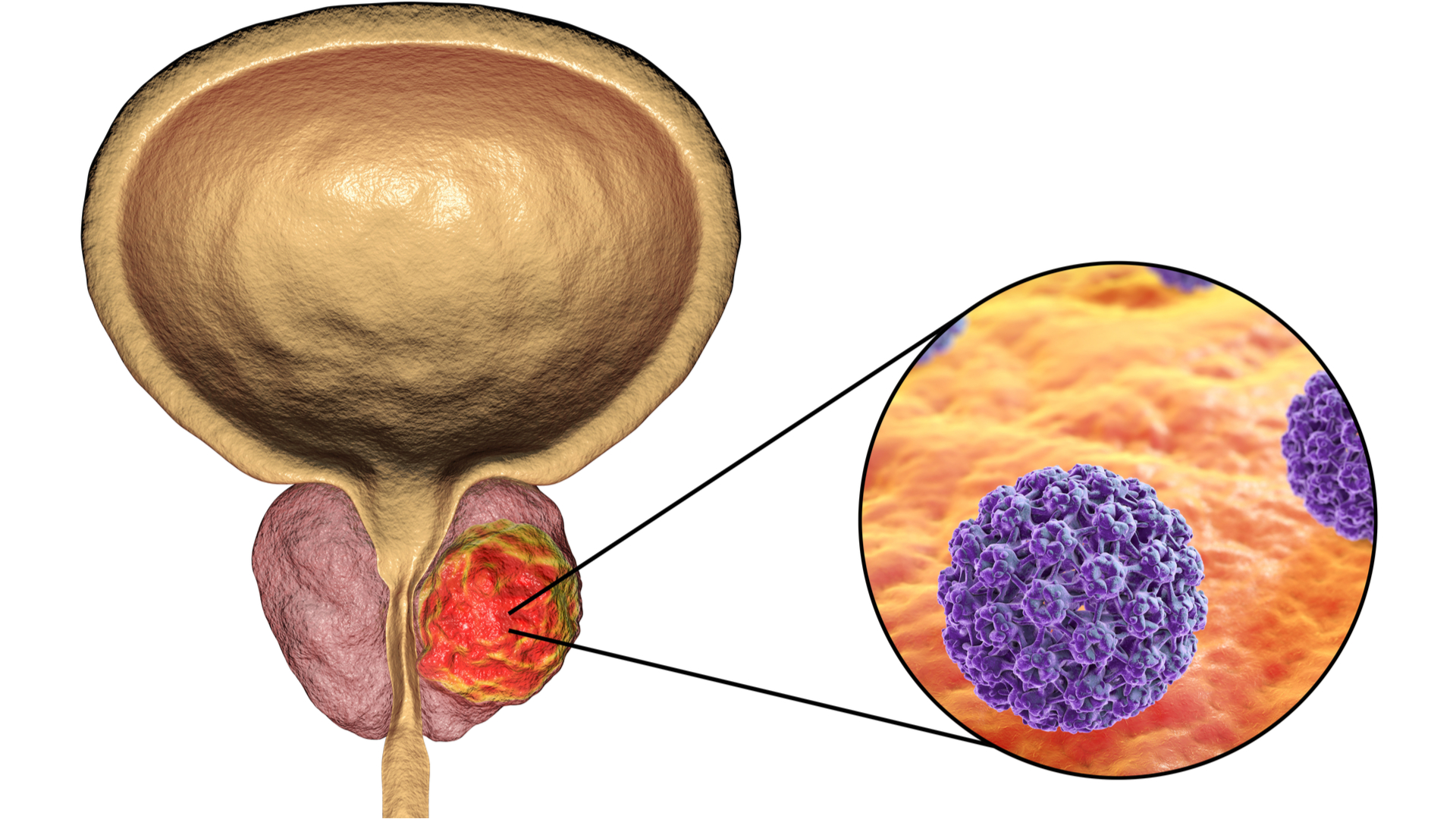 Простата крупным планом. Cancer предстательной железы. Раковые клетки простаты. Злокачественное новообразование простаты.