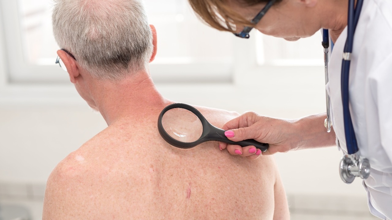tipos-de-cancer-de-piel-carcinoma-de-celulas-escamosas