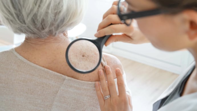 tipos de cancer de piel fotos melanoma