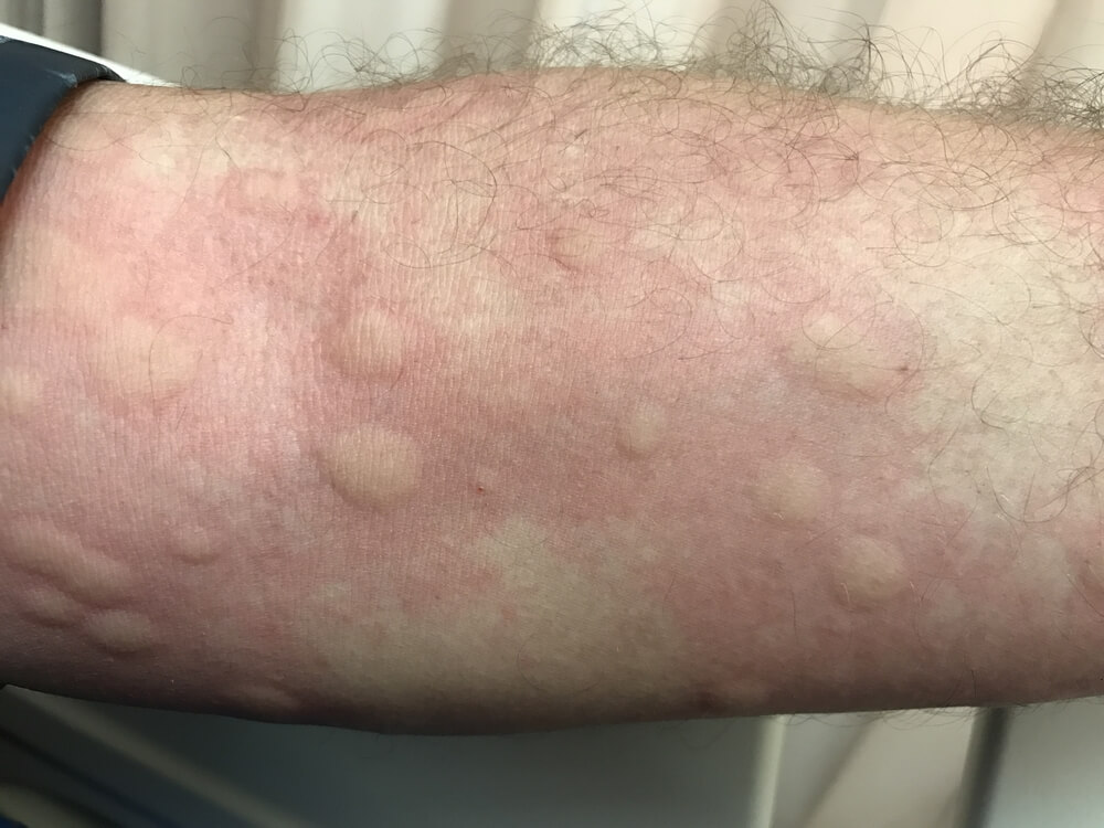 vacunas alergias 4