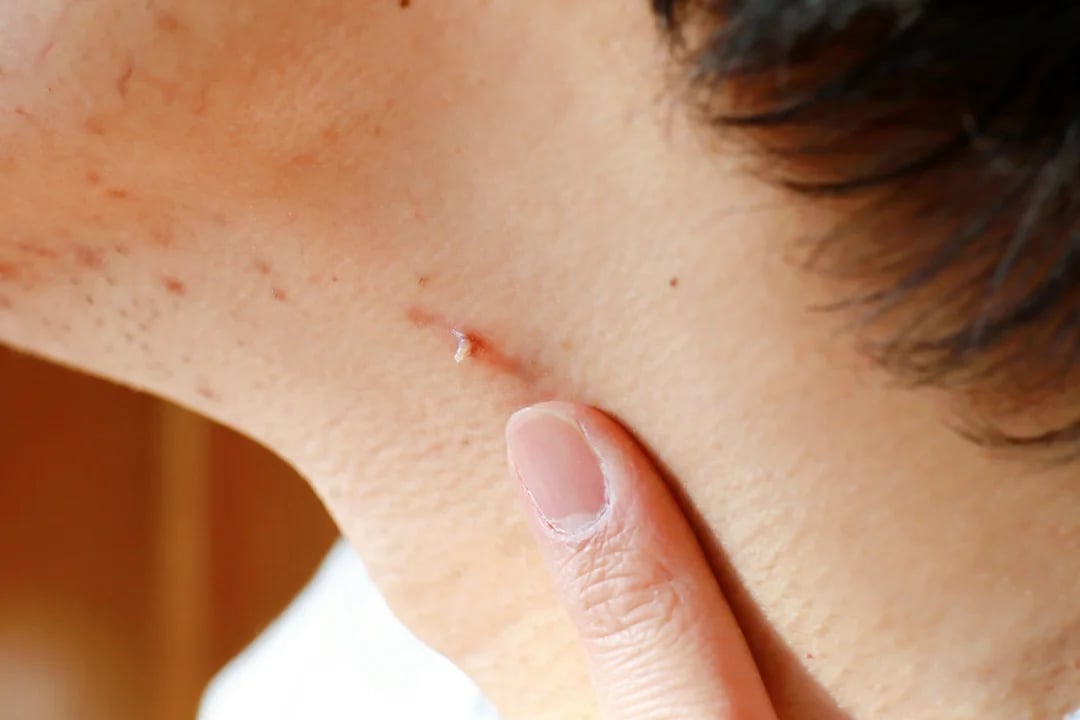 verrugas en cuello causas tratamiento