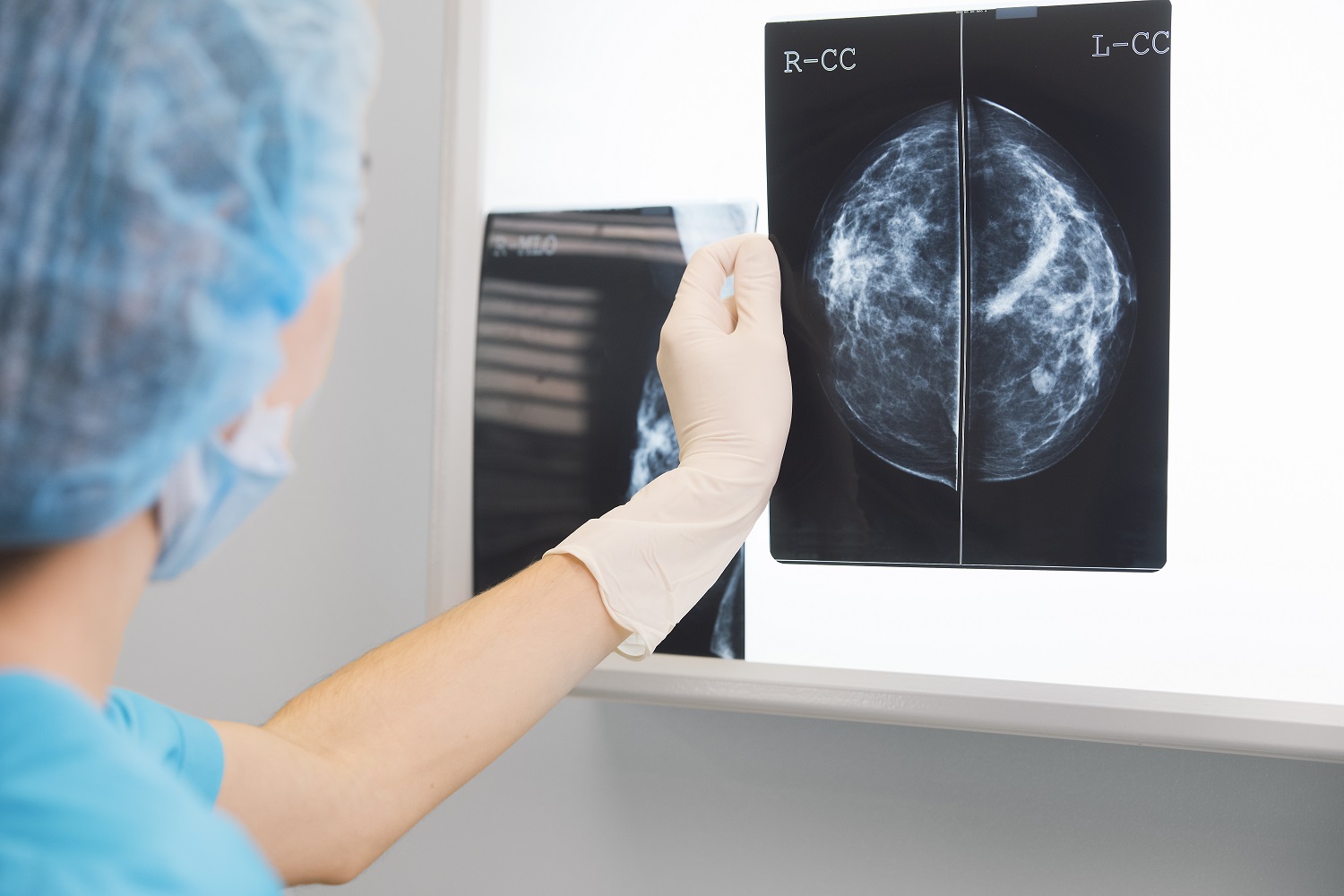 Mamografía vs autoexamen - 1