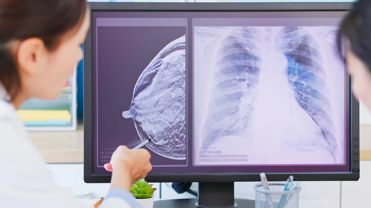 cancer de mama no invasivo diagnostico