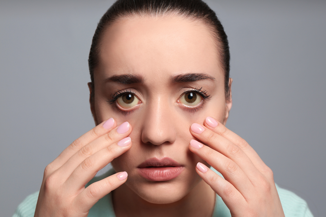 Causas de los Ojos Amarillos: Y Cómo se Trata