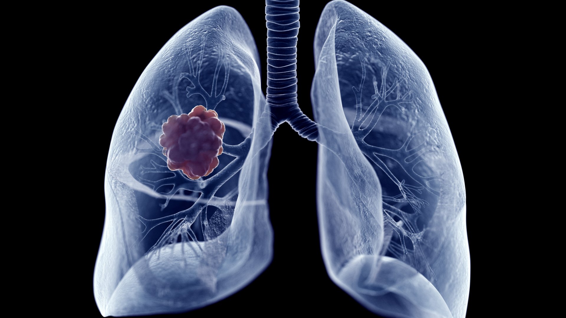 dia mundial del cancer de pulmon