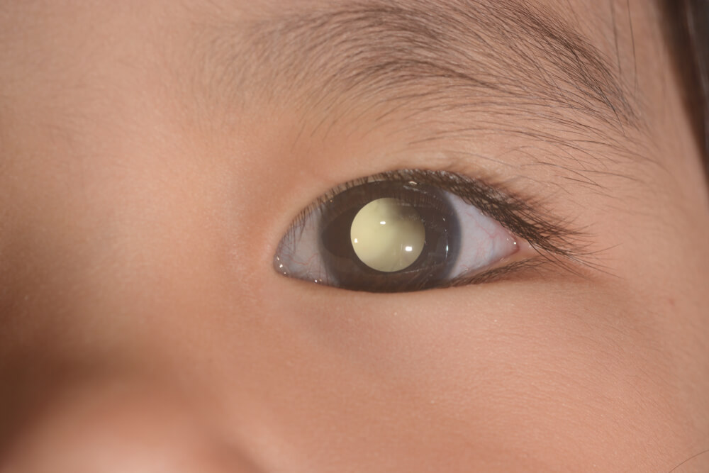 Retinoblastoma infantil