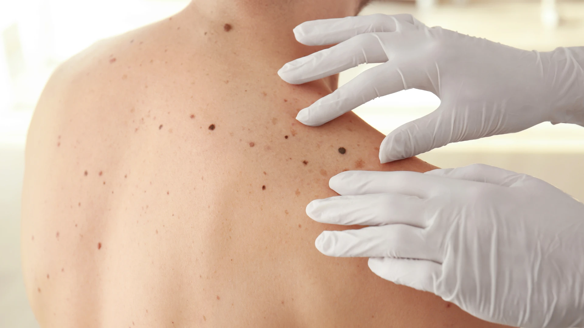 Tipos de cáncer de piel: todo lo que debes saber